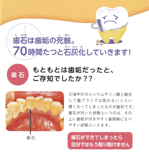 歯石、もともとは歯垢だったとご存知でしたか？