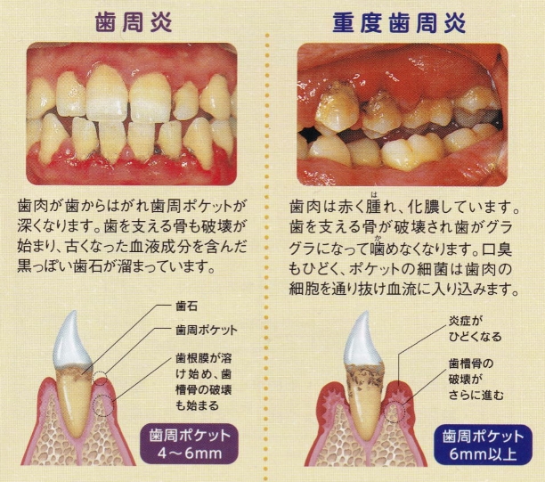 歯周炎、重度歯周炎